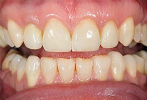 The image shows a close-up of a person s teeth, with the upper teeth prominently visible.
