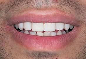 The image shows a close-up of a person s mouth with teeth, displaying a wide smile.