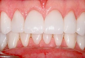 The image displays a close-up of a person s teeth with a focus on the front teeth, which are prominently white and well-maintained.