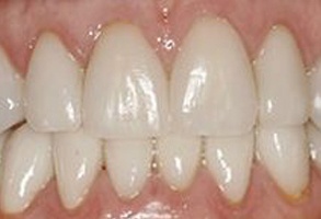 The image displays a close-up of a person s teeth, showcasing a set of white upper teeth with a visible yellowish stain on the lower front teeth.
