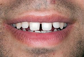 A close-up image of a person s mouth with teeth, showcasing a smile.