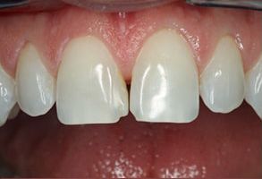 Dental implant with a natural-looking crown in place, showcasing the result of dental restoration.